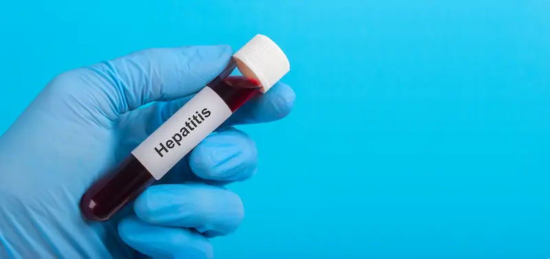 Hepatitis A Overview and Management